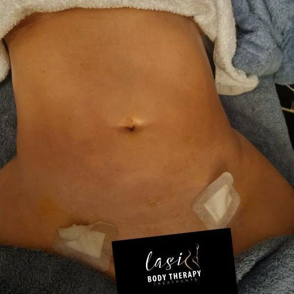 post lymphatic-drainage treatment